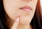Pimple Hacks: पिंपल्स से चाहिए छुट्टी, तो   अपनाएं इन घरेलू नुस्खों को