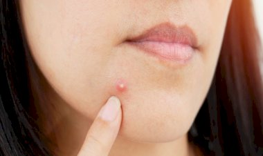 Pimple Hacks: पिंपल्स से चाहिए छुट्टी, तो   अपनाएं इन घरेलू नुस्खों को