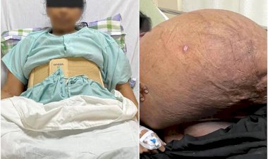 अहमदाबाद में डॉक्टरों ने महिला के पेट से निकाला 47 किलो ट्यूमर