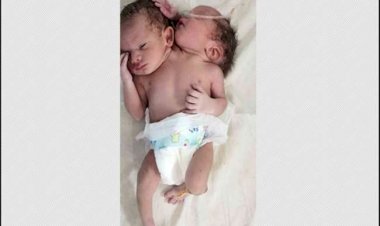 मध्य प्रदेश के रतलाम में दो सिर और तीन हाथ वाले अनोखे बच्चे का जन्म, हैरान रह गए डाक्टर
